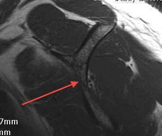 Suprascapular Nerve Sagittal MRI 2